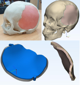 CRANIOPLASTY