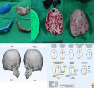 Craniosynostosis (1)